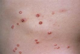 Image result for Pimples Caused by Molluscum