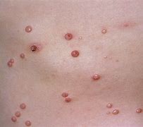 Image result for Molluscum Images