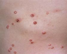 Image result for Molluscum Contagiosum Diagram