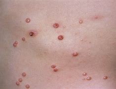 Image result for Maluscum Wart