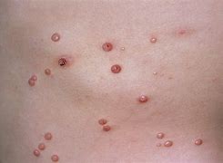 Image result for Molluscum Contagiosum Infection HIV