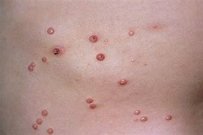 Image result for Molluscum Infection