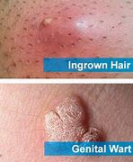 Image result for STD vs Ingrown Hair