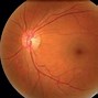 Image result for Diabetes Retinopathy Images