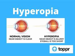Image result for Hyperopia
