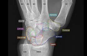 Image result for X-ray of Wrist AP