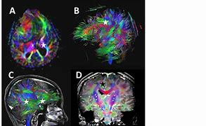 Image result for White Matter Tracts Transverse Section