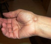 Image result for Lump Growing On Wrist