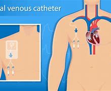 Image result for Centrel Venous Pressure