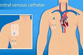 Image result for Pressure Caps Central Venous Catheter