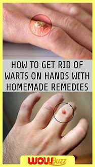 Image result for How to Get Rid Warts On Hands
