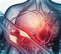Image result for Removing Plaque From Arteries