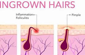 Image result for Genital Wart or Ingrown Hair