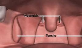 Image result for adenoidss