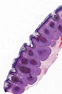 Image result for Molluscum Contagiosum Histology
