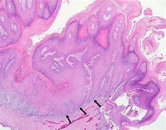 Image result for Verrucous Squamous Cell Carcinoma
