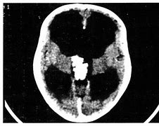 Image result for Choroid Plexus Papilloma 3rd Vrentricle