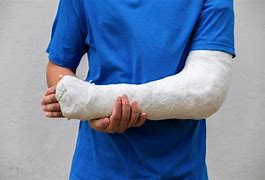 Image result for Gips Arm