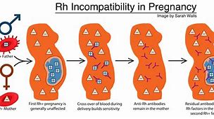 Image result for What Is RH Negative Pregnancy