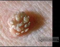 Image result for How to Treat Gential Wart