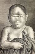 Image result for Cyclopia