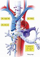 Image result for Hilar and Subcarinal Lymph Nodes