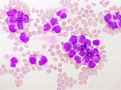 Image result for Acute Myelocytic Leukemia