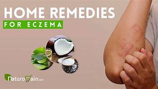 Image result for Eczema Home Remedy