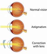 Image result for Astigmatism Eye Blood