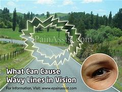 Image result for Peripheral Vision Blurry and Wavy
