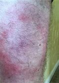 Image result for Apple Allergy Skin Rash