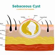 Image result for Sebaceous Cyst Scalp Skin Anatomy