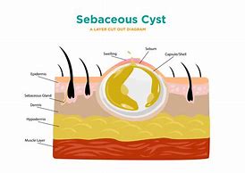 Image result for Sebaceous Cyst Diagram