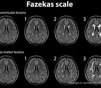 Image result for Fazekas Scale