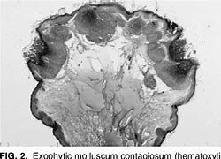Image result for Molluscum Contagiosum Black Skin