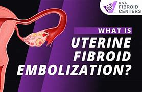 Image result for Uterine Fibroid Radiofrequency Ablation
