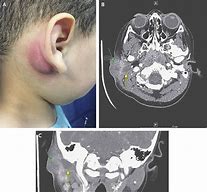 Image result for Cyst Concussion