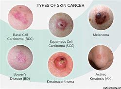 Image result for What Does Skin Cancer Look Like