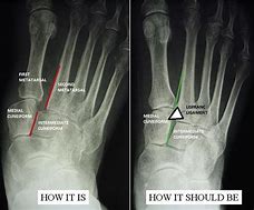 Image result for Lisfranc Fracture Plate