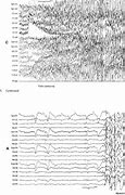 Image result for Atonic Seizure EEG