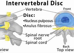 intervertebral discitis 的图像结果