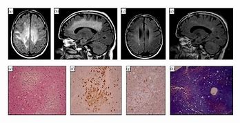 Image result for Supratentorial White Matter