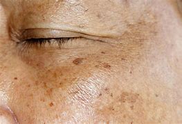 Image result for Age Spots Images