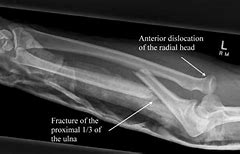 Image result for Closed Reduction Monteggia Fracture