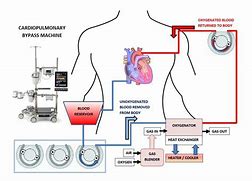 Image result for Blood Flow in Bypass Machine