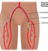 Image result for ICA Stent From Femoral Artery