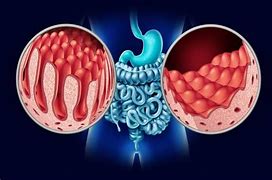 Image result for celiaco