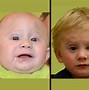 Image result for Surgery for Craniosynostosis