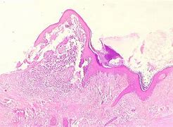 Image result for Verrucous Melanoma Histology