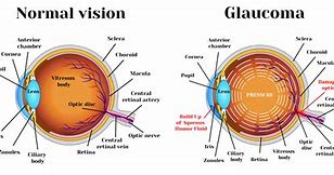 Image result for What Causes Glaucoma in Eyes
